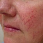 Купероз – признак алкоголизма?
