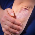 Псориаз и алкоголь: обострение заболевания